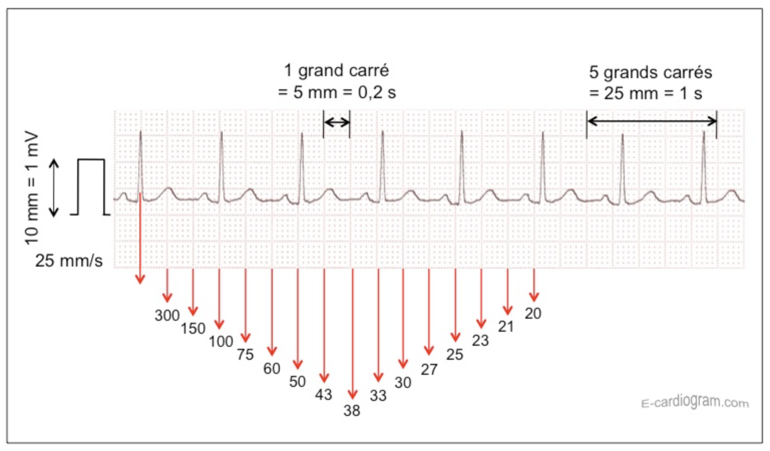 LEXIPatho: Électrocardiogramme (ECG) : Indications Et Interprétations